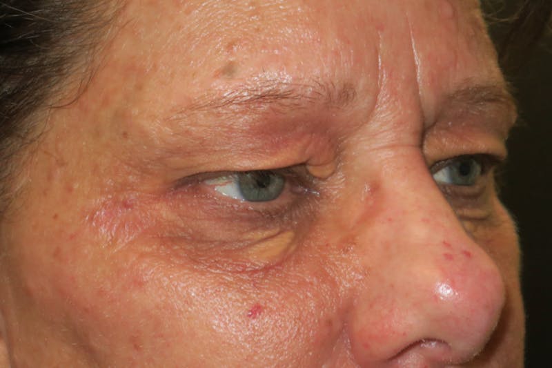 Eyelid Growth Removal Before & After Gallery - Patient 217728 - Image 5