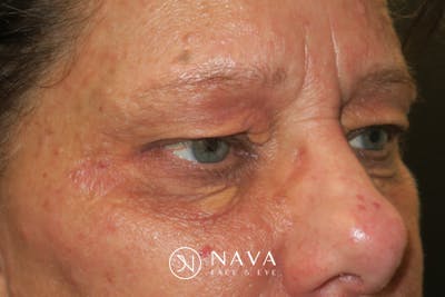 Upper Blepharoplasty (Upper Eyelid Surgery) Before & After Gallery - Patient 252123 - Image 5