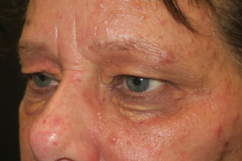 Eyelid Growth Removal Before & After Gallery - Patient 217728 - Image 3