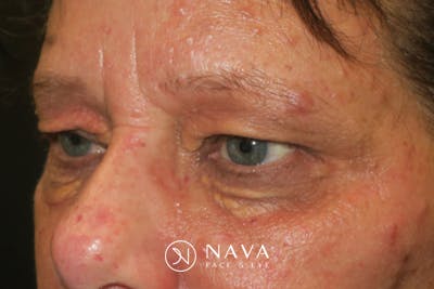 Upper Blepharoplasty (Upper Eyelid Surgery) Before & After Gallery - Patient 252123 - Image 3