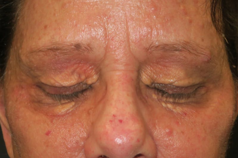 Eyelid Growth Removal Before & After Gallery - Patient 217728 - Image 7