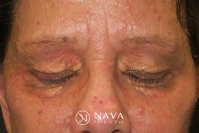 Upper Blepharoplasty (Upper Eyelid Surgery) Before & After Gallery - Patient 252123 - Image 7