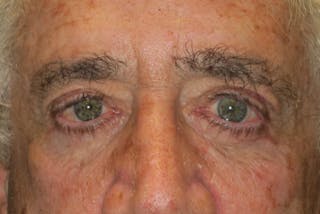 Browplasty (Brow Lift) Before & After Gallery - Patient 345878 - Image 2