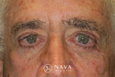 Ptosis Repair Before & After Gallery - Patient 279085 - Image 2