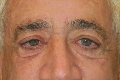 Ptosis Repair Before & After Gallery - Patient 279085 - Image 1