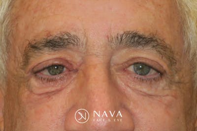 Ptosis Repair Before & After Gallery - Patient 279085 - Image 1