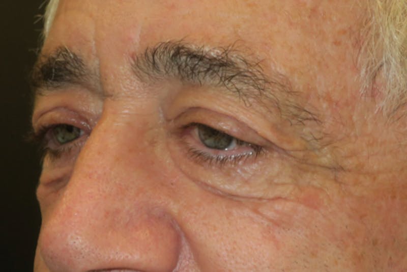Lower Blepharoplasty (Lower Eyelid Surgery) Before & After Gallery - Patient 168036 - Image 3