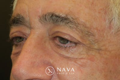 Ptosis Repair Before & After Gallery - Patient 279085 - Image 3