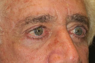 Browplasty (Brow Lift) Before & After Gallery - Patient 345878 - Image 6