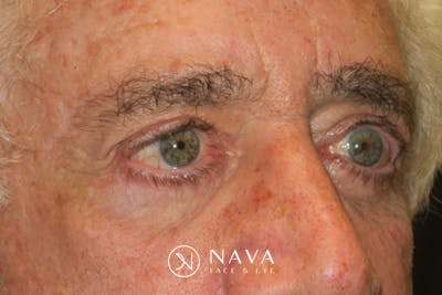 Ptosis Repair Before & After Gallery - Patient 279085 - Image 6