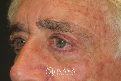 Ptosis Repair Before & After Gallery - Patient 279085 - Image 4
