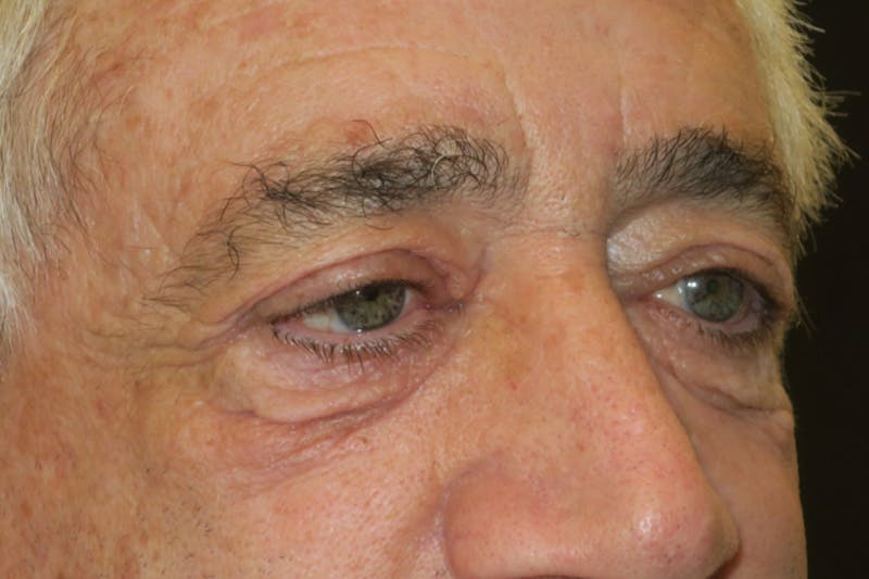 Lower Blepharoplasty (Lower Eyelid Surgery) Before & After Gallery - Patient 168036 - Image 5