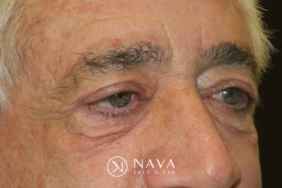 Ptosis Repair Before & After Gallery - Patient 279085 - Image 5