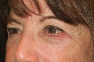 Lower Blepharoplasty (Lower Eyelid Surgery) Before & After Gallery - Patient 831356 - Image 6