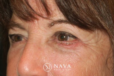 Lower Blepharoplasty (Lower Eyelid Surgery) Before & After Gallery - Patient 831356 - Image 6