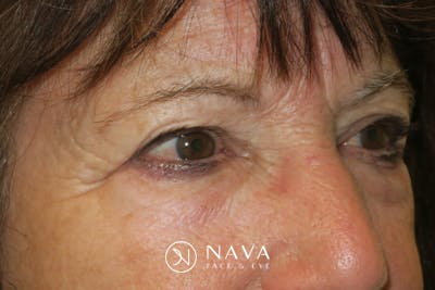 Lower Blepharoplasty (Lower Eyelid Surgery) Before & After Gallery - Patient 831356 - Image 3