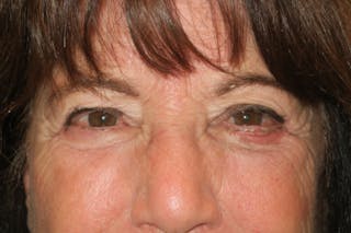 Lower Blepharoplasty (Lower Eyelid Surgery) Before & After Gallery - Patient 831356 - Image 2