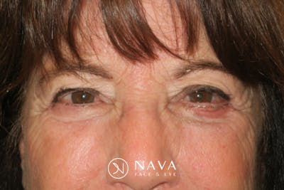 Lower Blepharoplasty (Lower Eyelid Surgery) Before & After Gallery - Patient 831356 - Image 2