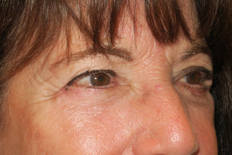 Lower Blepharoplasty (Lower Eyelid Surgery) Before & After Gallery - Patient 831356 - Image 4