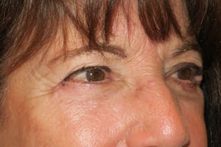 Lower Blepharoplasty (Lower Eyelid Surgery) Before & After Gallery - Patient 831356 - Image 4