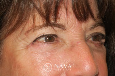 Lower Blepharoplasty (Lower Eyelid Surgery) Before & After Gallery - Patient 831356 - Image 4