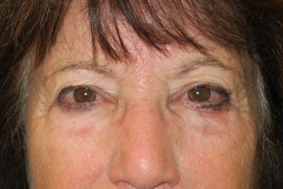 Lower Blepharoplasty (Lower Eyelid Surgery) Before & After Gallery - Patient 831356 - Image 1