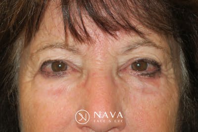 Lower Blepharoplasty (Lower Eyelid Surgery) Before & After Gallery - Patient 831356 - Image 1