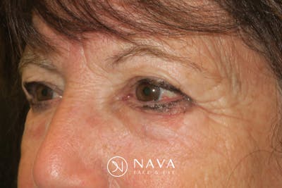 Lower Blepharoplasty (Lower Eyelid Surgery) Before & After Gallery - Patient 831356 - Image 5