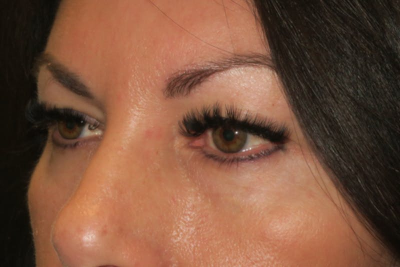Upper Blepharoplasty (Upper Eyelid Surgery) Before & After Gallery - Patient 650096 - Image 5