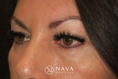 Upper Blepharoplasty (Upper Eyelid Surgery) Before & After Gallery - Patient 650096 - Image 5