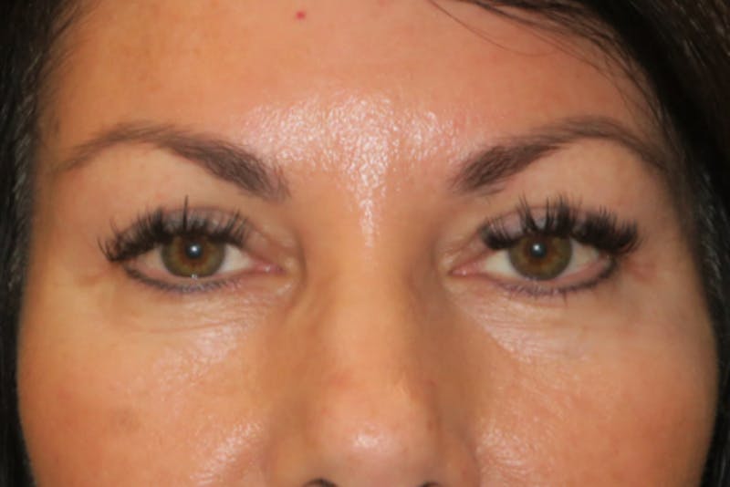Upper Blepharoplasty (Upper Eyelid Surgery) Before & After Gallery - Patient 650096 - Image 2
