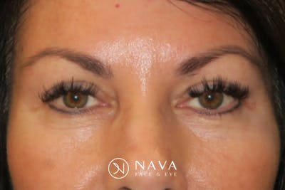 Upper Blepharoplasty (Upper Eyelid Surgery) Before & After Gallery - Patient 650096 - Image 2