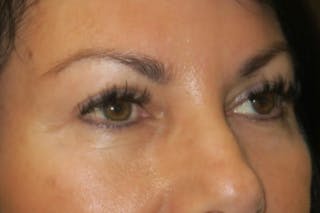 Upper Blepharoplasty (Upper Eyelid Surgery) Before & After Gallery - Patient 650096 - Image 4