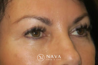 Upper Blepharoplasty (Upper Eyelid Surgery) Before & After Gallery - Patient 650096 - Image 4