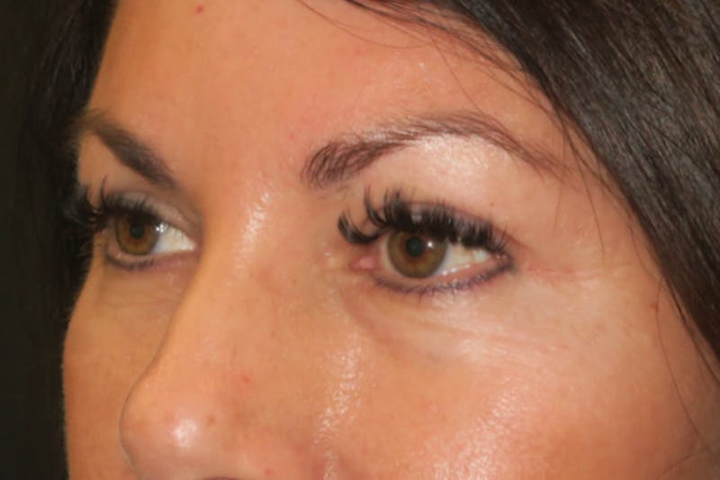 Upper Blepharoplasty (Upper Eyelid Surgery) Before & After Gallery - Patient 650096 - Image 6