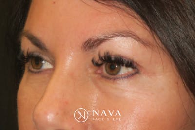 Upper Blepharoplasty (Upper Eyelid Surgery) Before & After Gallery - Patient 650096 - Image 6