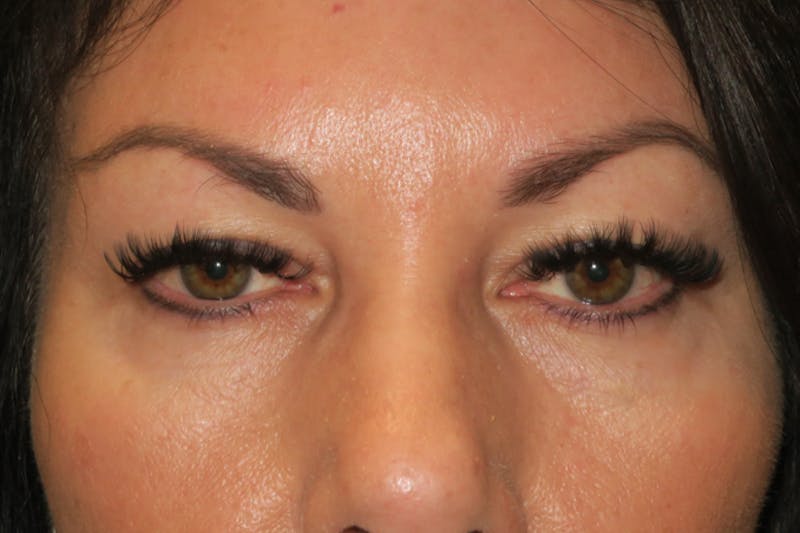 Upper Blepharoplasty (Upper Eyelid Surgery) Before & After Gallery - Patient 650096 - Image 1