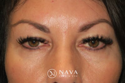 Upper Blepharoplasty (Upper Eyelid Surgery) Before & After Gallery - Patient 650096 - Image 1