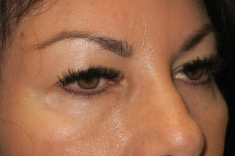 Upper Blepharoplasty (Upper Eyelid Surgery) Before & After Gallery - Patient 650096 - Image 3