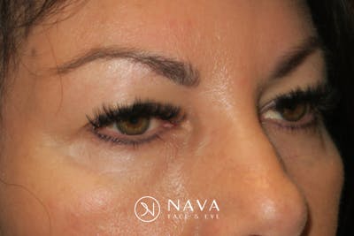 Upper Blepharoplasty (Upper Eyelid Surgery) Before & After Gallery - Patient 650096 - Image 3