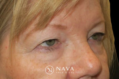Upper Blepharoplasty (Upper Eyelid Surgery) Before & After Gallery - Patient 149265 - Image 3