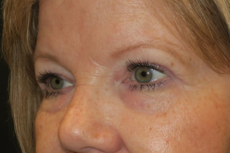 Upper Blepharoplasty (Upper Eyelid Surgery) Before & After Gallery - Patient 149265 - Image 6