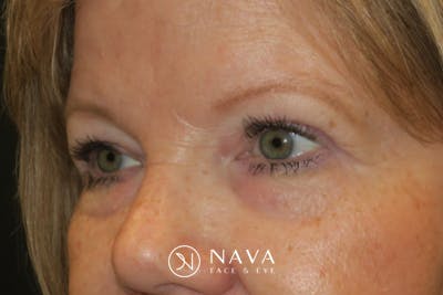 Upper Blepharoplasty (Upper Eyelid Surgery) Before & After Gallery - Patient 149265 - Image 6