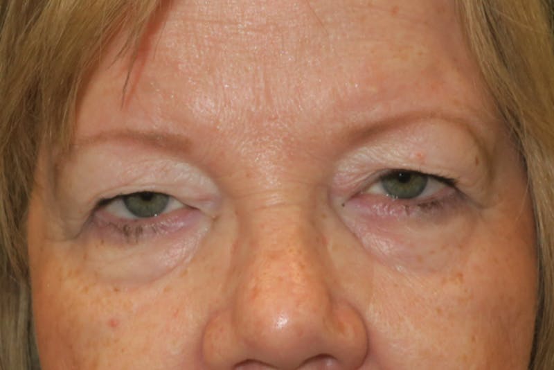 Upper Blepharoplasty (Upper Eyelid Surgery) Before & After Gallery - Patient 149265 - Image 1