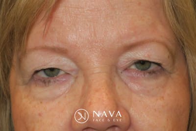 Upper Blepharoplasty (Upper Eyelid Surgery) Before & After Gallery - Patient 149265 - Image 1
