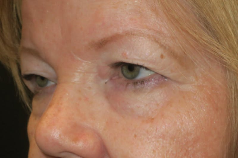 Upper Blepharoplasty (Upper Eyelid Surgery) Before & After Gallery - Patient 149265 - Image 5