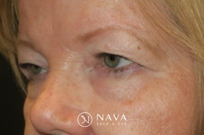 Upper Blepharoplasty (Upper Eyelid Surgery) Before & After Gallery - Patient 149265 - Image 5