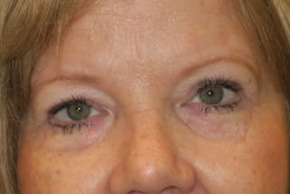 Upper Blepharoplasty (Upper Eyelid Surgery) Before & After Gallery - Patient 149265 - Image 2