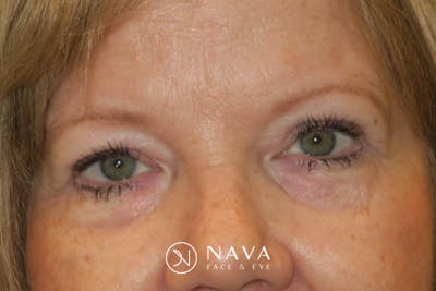 Upper Blepharoplasty (Upper Eyelid Surgery) Before & After Gallery - Patient 149265 - Image 2