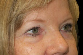 Upper Blepharoplasty (Upper Eyelid Surgery) Before & After Gallery - Patient 149265 - Image 4